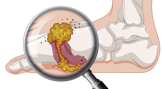 dieta hiperuricemia gota