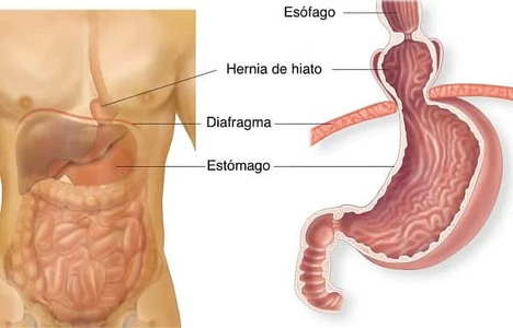 hernia de hiato