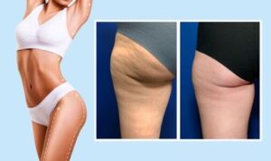 dieta para reducir y eliminar la celulitis
